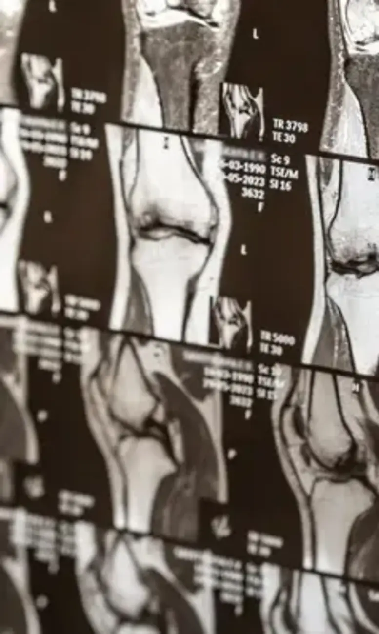 Bone scan image